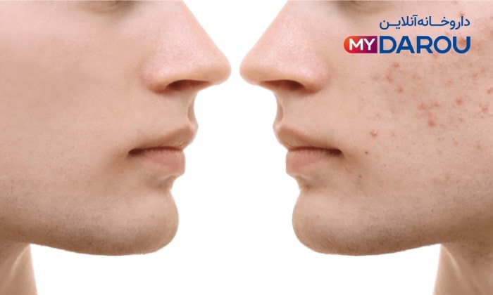 کرم ضد جوش برای نوجوانان 